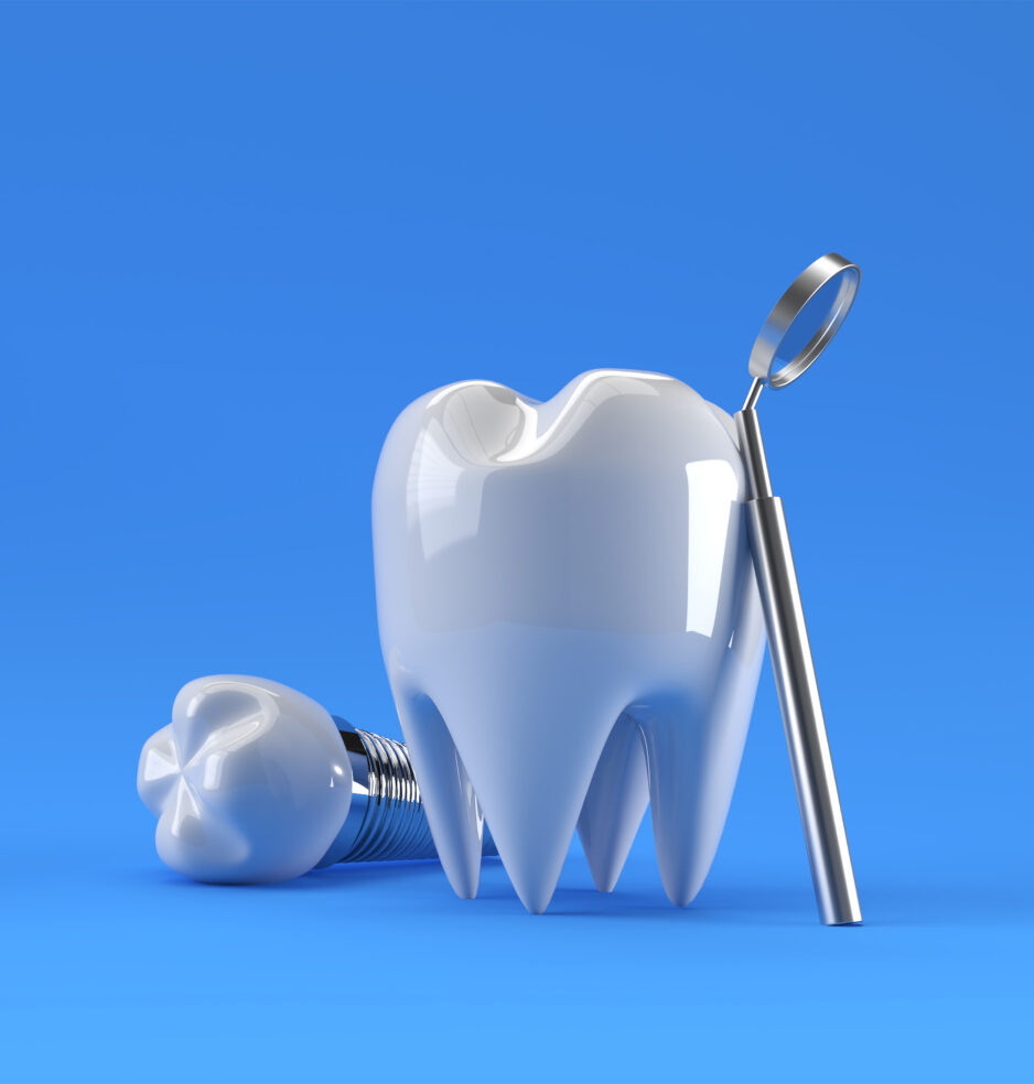 Implantul dentar, soluția modernă pentru zâmbete perfecte