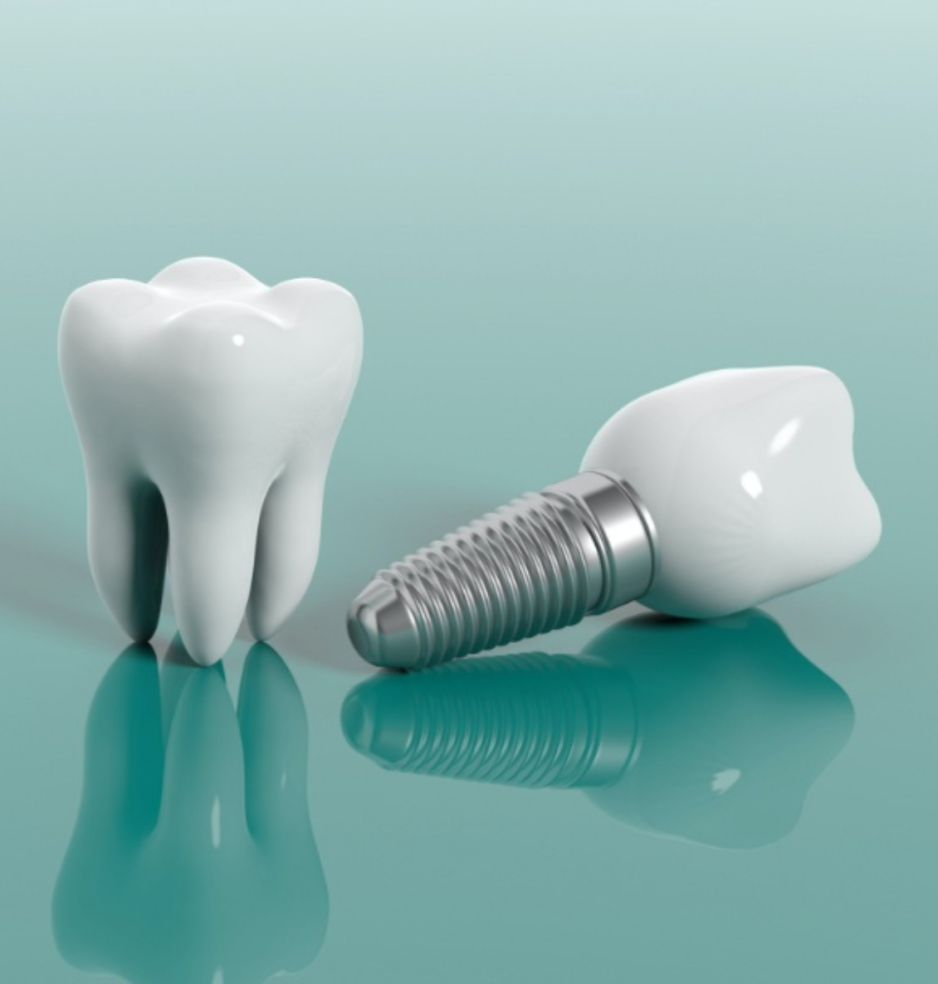Etapele unui implant dentar: ghid complet pentru un zâmbet sănătos și strălucitor