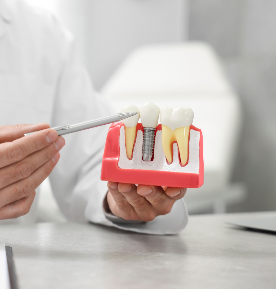 Cele mai frecvente 10 întrebări legate de implantul dentar